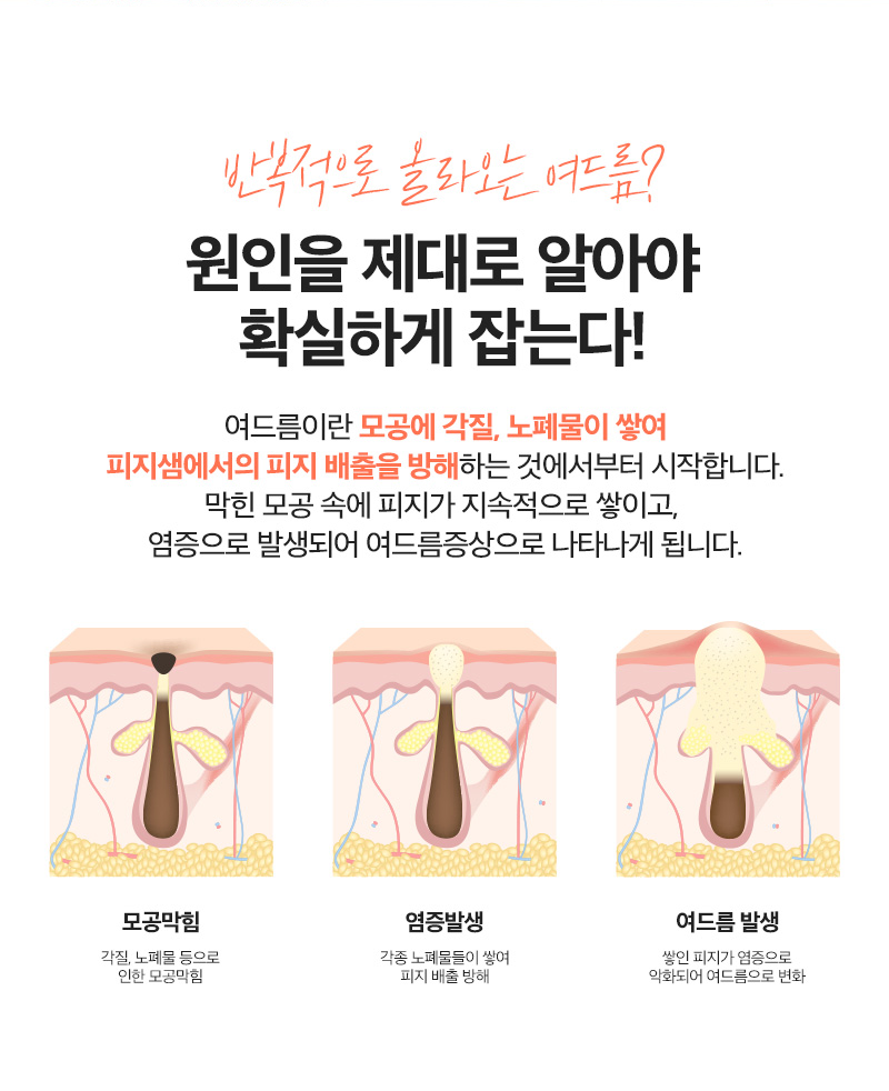 리엔장 여드름케어 원인