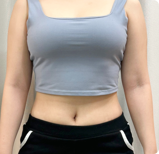 복부전체, 러브핸들, 뒷구리, 허벅지 시술 후