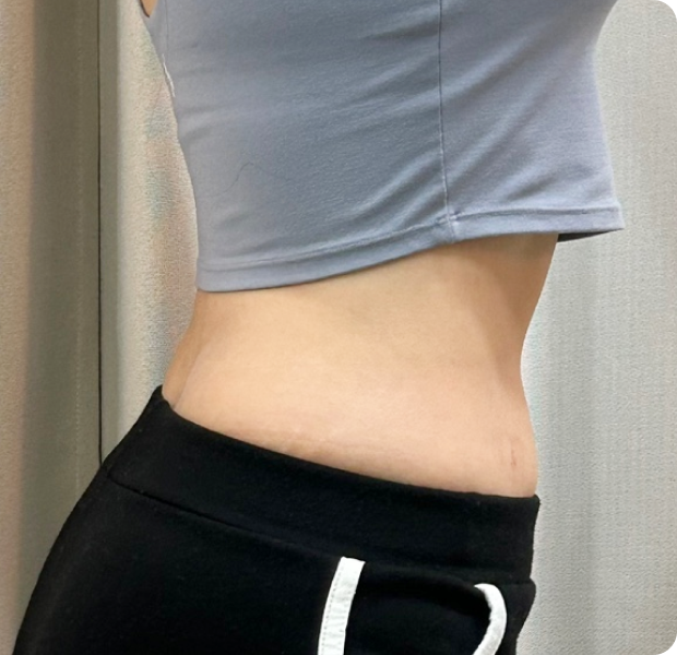 복부전체, 러브핸들, 뒷구리 시술 후