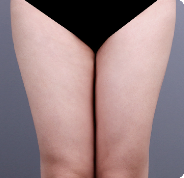 허벅지 시술 후