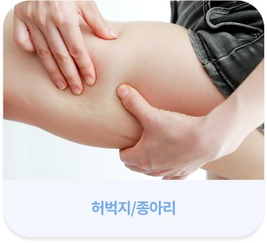살빼주사 시술 부위 안내 이미지 종아리